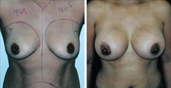 Breast Augmentation Patient Before & After Photo 1