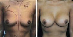 Breast Augmentation Patient Before & After Photo 1