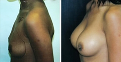 Breast Augmentation Patient Before & After Photo 1