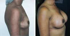 Breast Augmentation Patient Before & After Photo 1