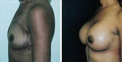 Breast Augmentation Patient Before & After Photo 1