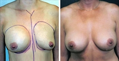 Breast Augmentation Patient Before & After Photo 1