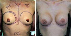 Breast Augmentation Patient Before & After Photo 1