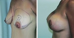 Breast Augmentation Patient Before & After Photo 1