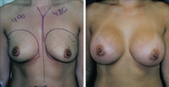 Breast Augmentation Patient Before & After Photo 1