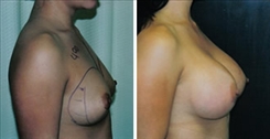 Breast Augmentation Patient Before & After Photo 1