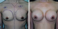 Breast Augmentation Patient Before & After Photo 1