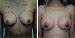 Breast Augmentation Patient Before & After Photo 1