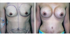 Breast Augmentation Patient Before & After Photo 1