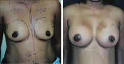 Breast Augmentation Patient Before & After Photo 1