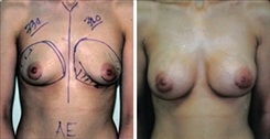 Breast Augmentation Patient Before & After Photo 1