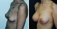 Breast Augmentation Patient Before & After Photo 1