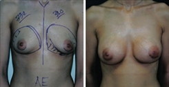 Breast Augmentation Patient Before & After Photo 1