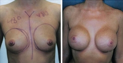 Breast Augmentation Patient Before & After Photo 1