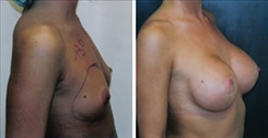 Breast Augmentation Patient Before & After Photo 1