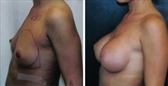 Breast Augmentation Patient Before & After Photo 1