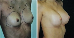 Breast Augmentation Patient Before & After Photo 1