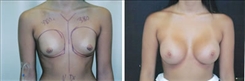 Breast Augmentation Patient Before & After Photo 1