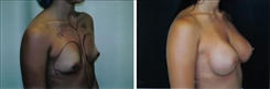 Breast Augmentation Patient Before & After Photo 1