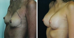 Breast Augmentation Patient Before & After Photo 1