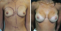 Breast Augmentation Patient Before & After Photo 1