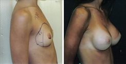 Breast Augmentation Patient Before & After Photo 1