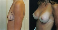 Breast Augmentation Patient Before & After Photo 1