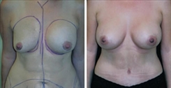 Breast Augmentation Patient Before & After Photo 1