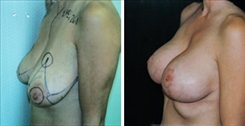 Breast Augmentation Patient Before & After Photo 1