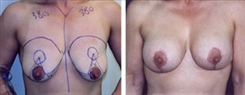 Breast Augmentation Patient Before & After Photo 1