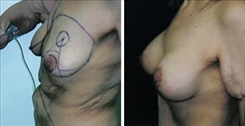 Breast Augmentation Patient Before & After Photo 1