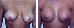 Breast Augmentation Patient Before & After Photo 1