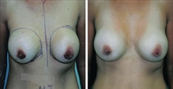 Breast Augmentation Patient Before & After Photo 1