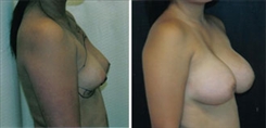 Breast Augmentation Patient Before & After Photo 1