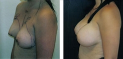 Breast Augmentation Patient Before & After Photo 1