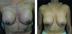 Breast Augmentation Patient Before & After Photo 1