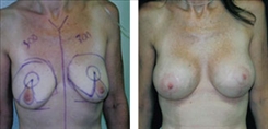 Breast Augmentation Patient Before & After Photo 1