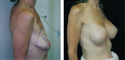 Breast Augmentation Patient Before & After Photo 1