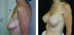 Breast Augmentation Patient Before & After Photo 1