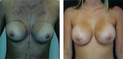 Breast Augmentation Patient Before & After Photo 1