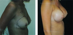 Breast Augmentation Patient Before & After Photo 1