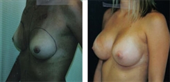 Breast Augmentation Patient Before & After Photo 1