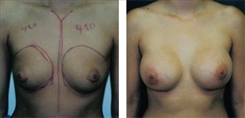 Breast Augmentation Patient Before & After Photo 1