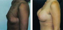 Breast Augmentation Patient Before & After Photo 1