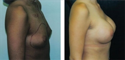 Breast Augmentation Patient Before & After Photo 1