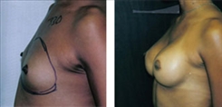 Breast Augmentation Patient Before & After Photo 1