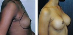 Breast Augmentation Patient Before & After Photo 1