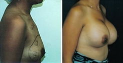 Breast Augmentation Patient Before & After Photo 1