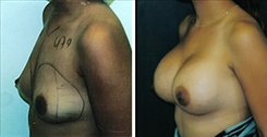 Breast Augmentation Patient Before & After Photo 1