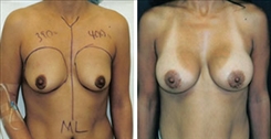 Breast Augmentation Patient Before & After Photo 1